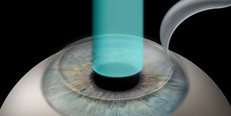 What Is And When Should I Consider Refractive Surgery ?